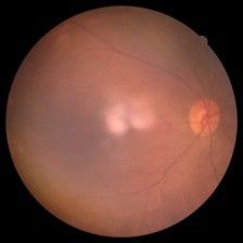 Fotografía de fondo de ojo, caso 109