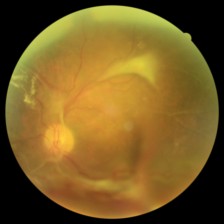 Fotografía de fondo de ojo, caso 238