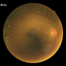 Fotografía de fondo de ojo, caso 273
