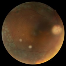 Fotografía de fondo de ojo, caso 322
